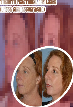 Fractional resurfacing cost