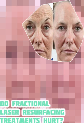 Fx facial laser resurfacing
