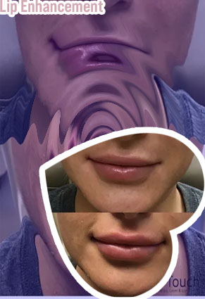 Male lip enhancement