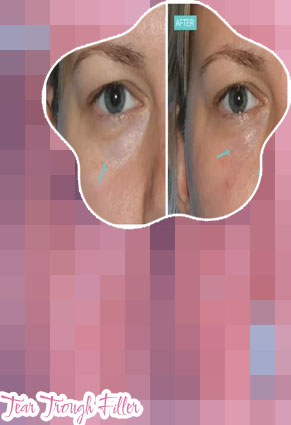 Mens tear trough filler