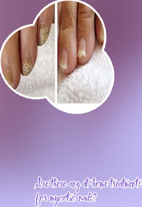 Onychomycosis home treatment